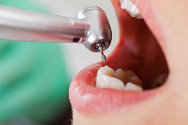 Best Lost Filling or Crown Replacement in Dunkirk, MD